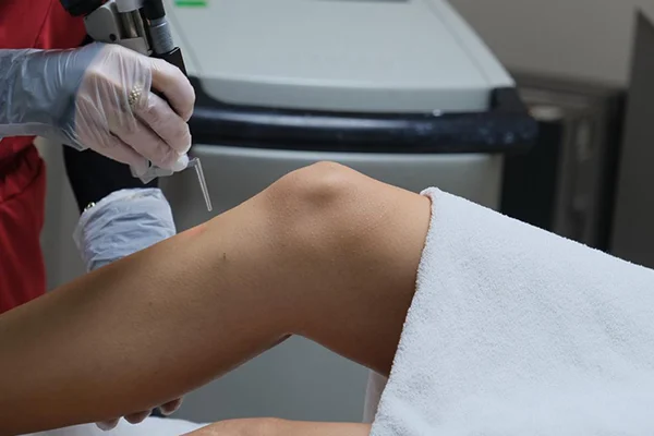 Alexandrite Lazer Epilasyon