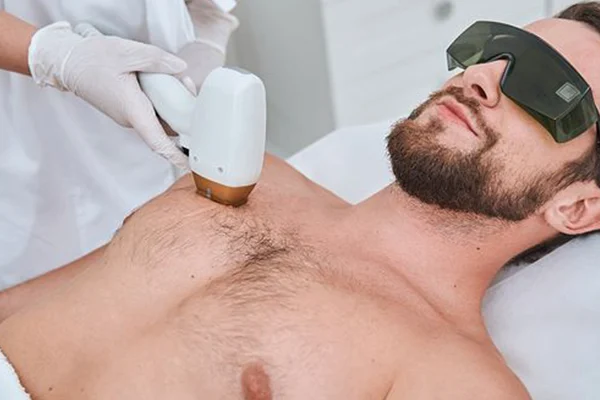 Erkek Lazer Epilasyon