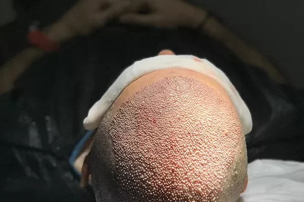 Saç Ekimi Fiyatları