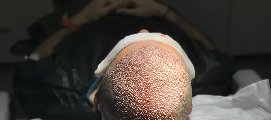 saç ekimi fiyatları