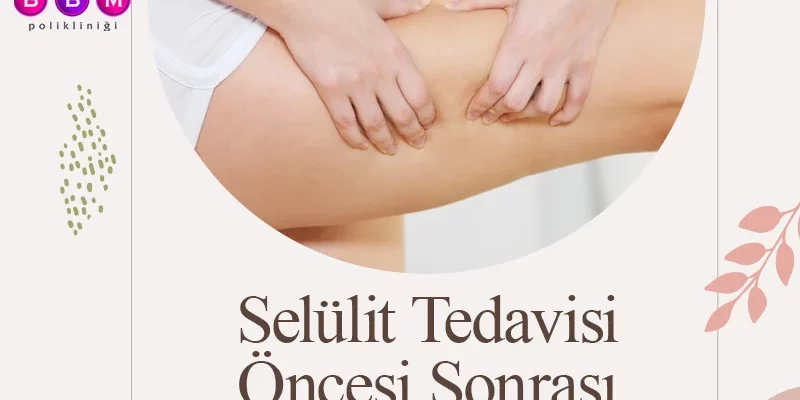 Selülit Tedavisi Öncesi Sonrası