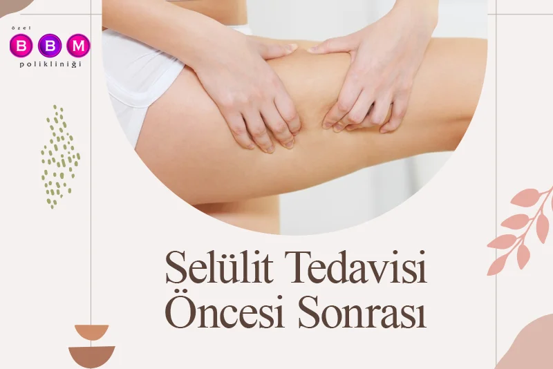 Selülit Tedavisi Öncesi Sonrası