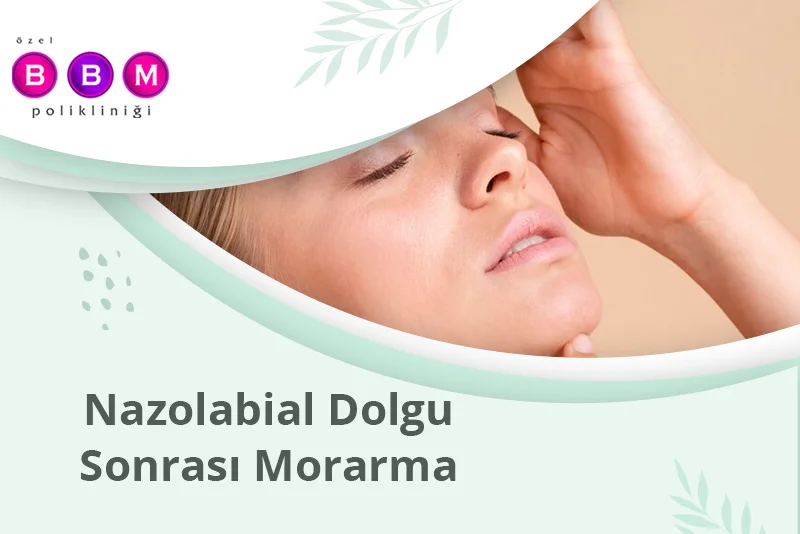 Nazolabial Dolgu Sonrası Morarma