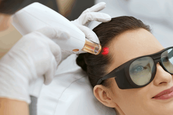 Saç Lazeri Tedavisi