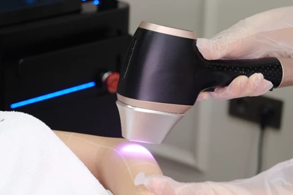 Nd:YAG Lazer Epilasyon