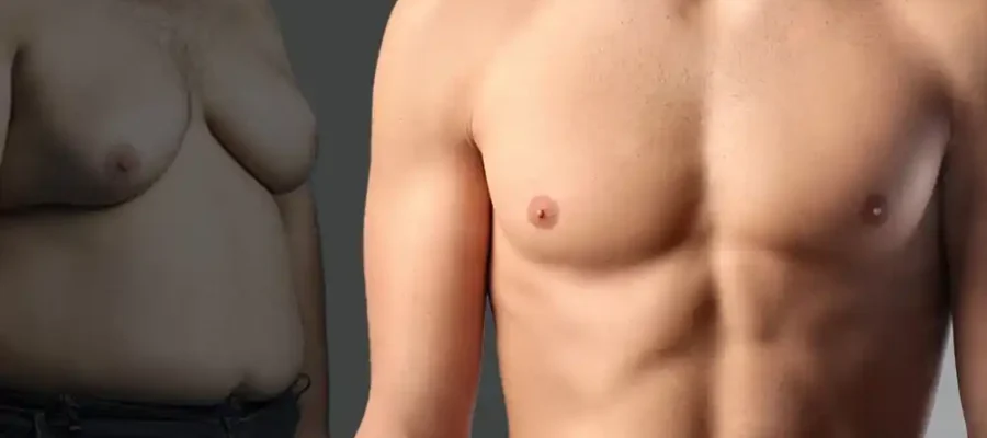 Jinekomasti Olmamak Dikkat Edilmesi Gereken 5 Şey