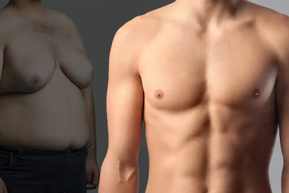 Jinekomasti Olmamak Dikkat Edilmesi Gereken 5 Şey